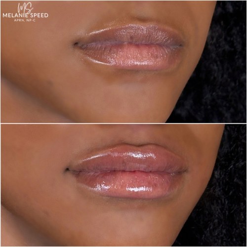 Lip Augmentation Before & After Photos by Flawless MedSpa & The Beverly Hills MedSpa in Beverly Hills, CA and Las Vegas, NV