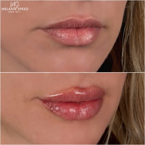 Lip Augmentation Before & After Photos by Flawless MedSpa & The Beverly Hills MedSpa in Beverly Hills, CA and Las Vegas, NV