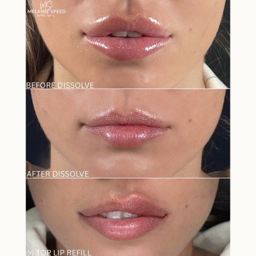 Lip Augmentation Before & After Photos by Flawless MedSpa & The Beverly Hills MedSpa in Beverly Hills, CA and Las Vegas, NV