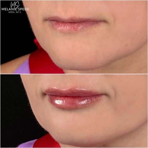 Lip Augmentation Before & After Photos by Flawless MedSpa & The Beverly Hills MedSpa in Beverly Hills, CA and Las Vegas, NV