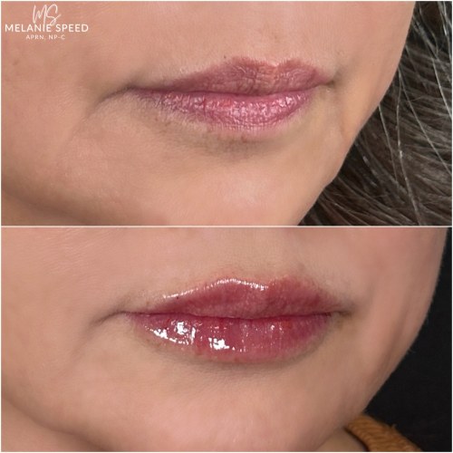Lip Augmentation Before & After Photos by Flawless MedSpa & The Beverly Hills MedSpa in Beverly Hills, CA and Las Vegas, NV