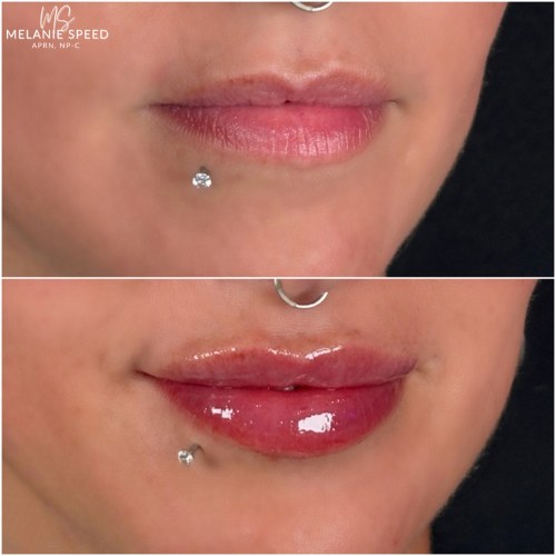 Lip Augmentation Before & After Photos by Flawless MedSpa & The Beverly Hills MedSpa in Beverly Hills, CA and Las Vegas, NV