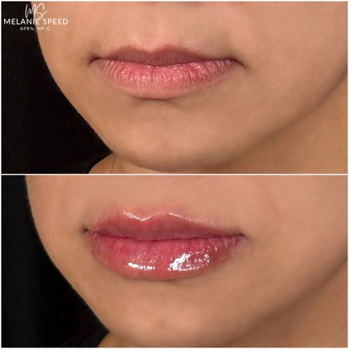 Lip Augmentation Before & After Photos by Flawless MedSpa & The Beverly Hills MedSpa in Beverly Hills, CA and Las Vegas, NV